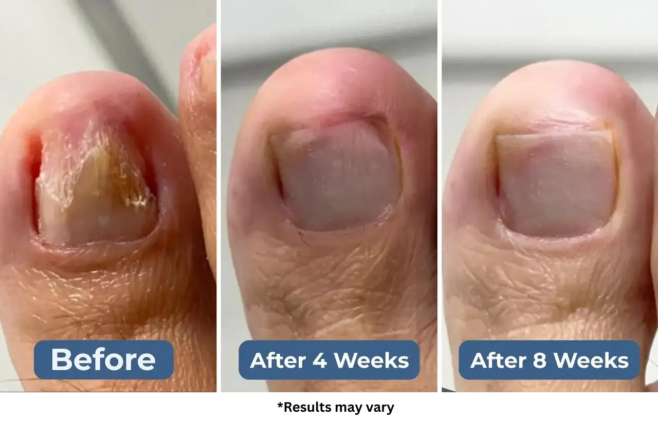 Okita Nail Fungus Light Before and After